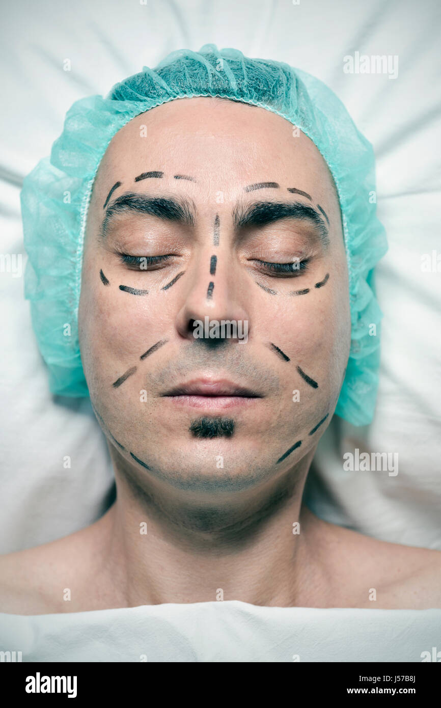 high-angle shot of the head of a young caucasian man who is about to have a plastic surgery, with a medical disposable cap and with surgery lines mark Stock Photo