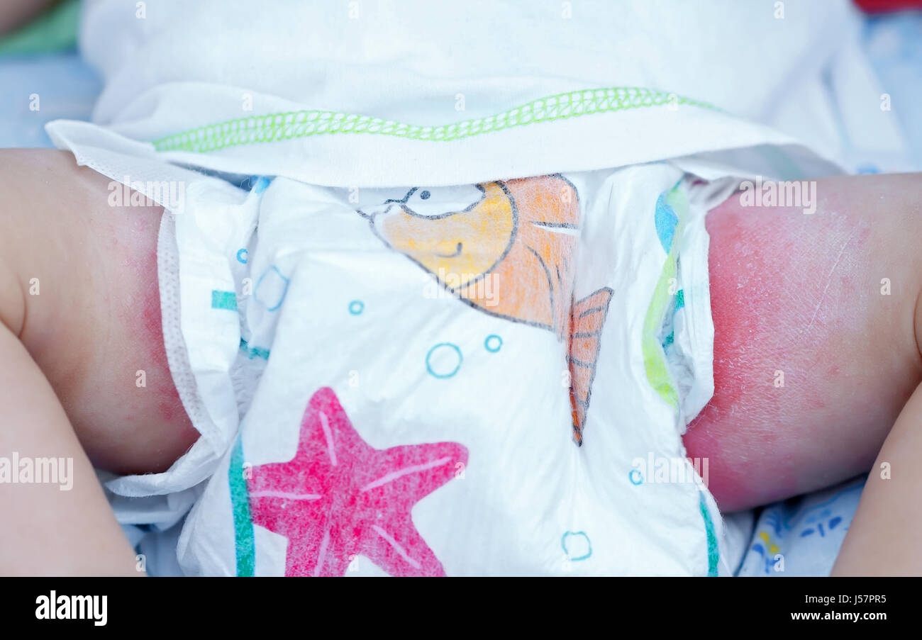 Diaper Rash With White Bumps