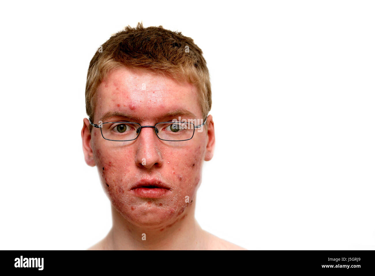 problem itch pimple acne skin disease dermatologist stem teens