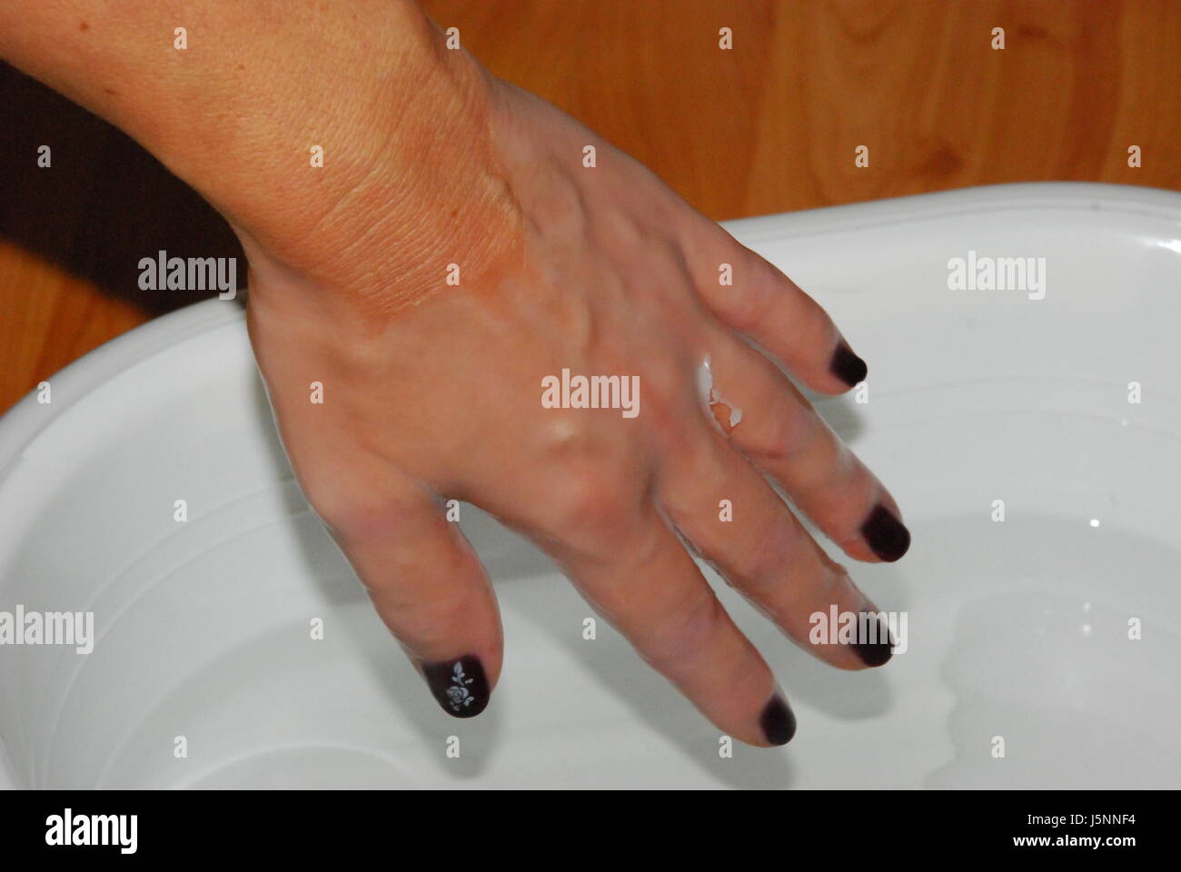 hand in paraffin bath 2 Stock Photo Alamy