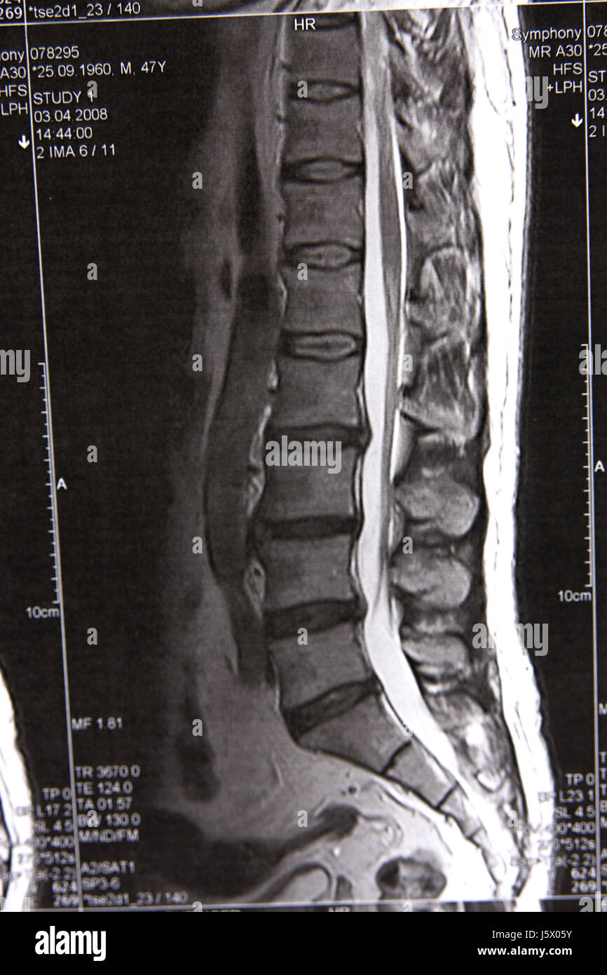 Mri of herniated disc hi-res stock photography and images - Alamy