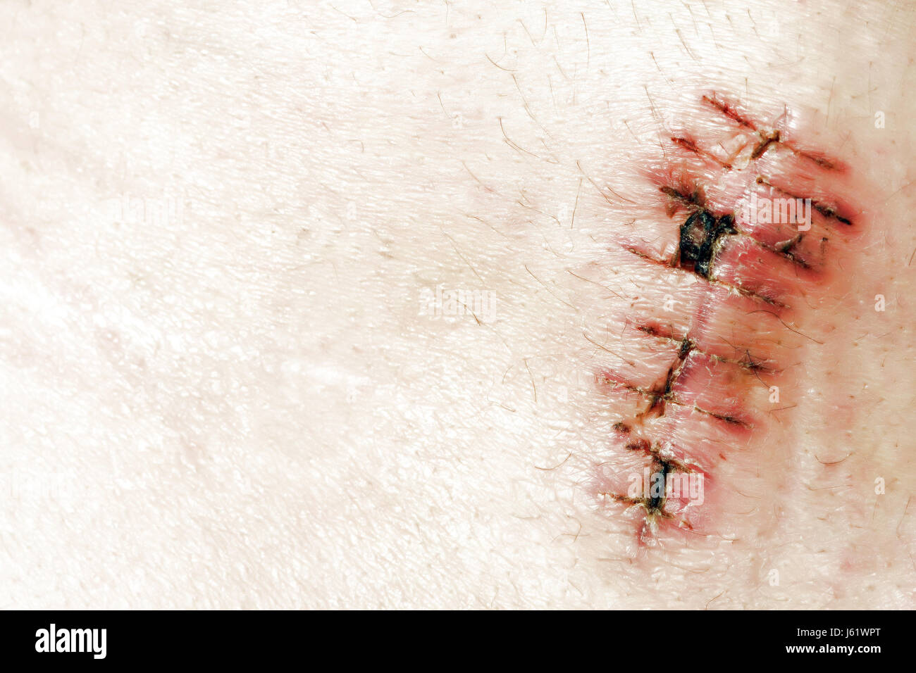medicinally medical skin pain wound injury scar surgery heal close health Stock Photo