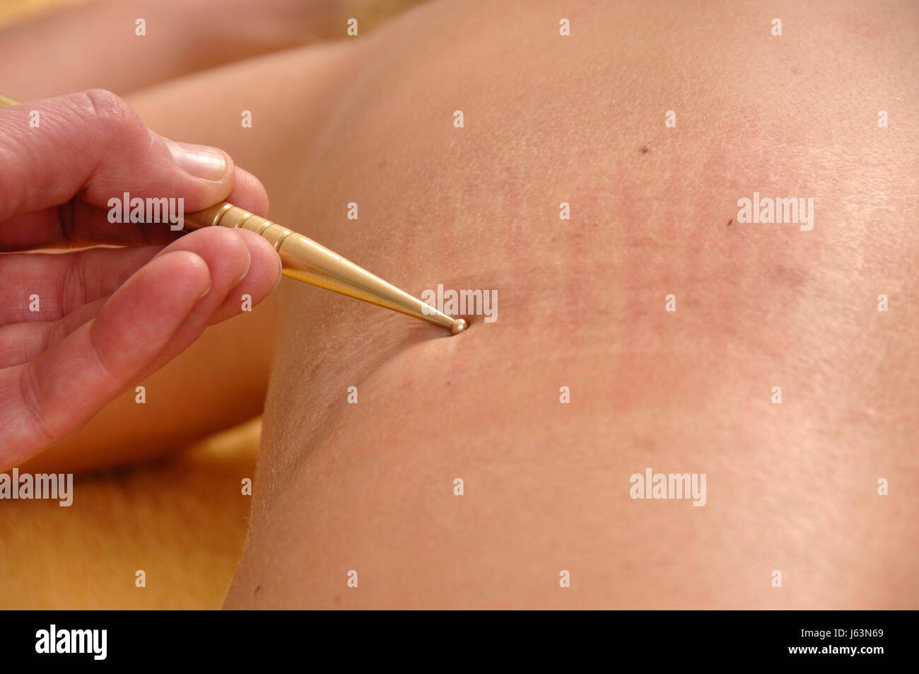 alternative acupuncture treatment therapy practice pratice woman women Stock Photo