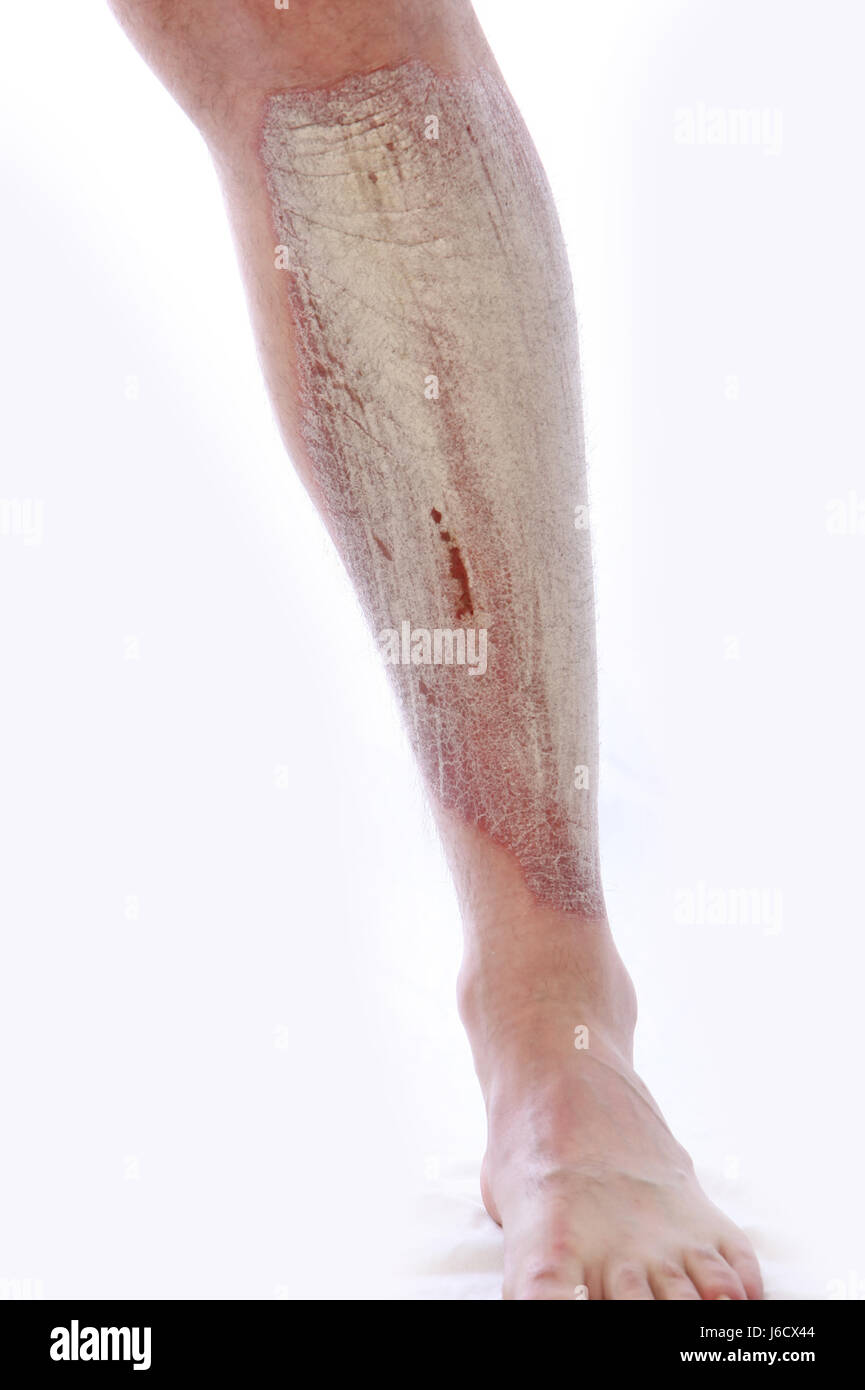 psoriasis on leg Stock Photo