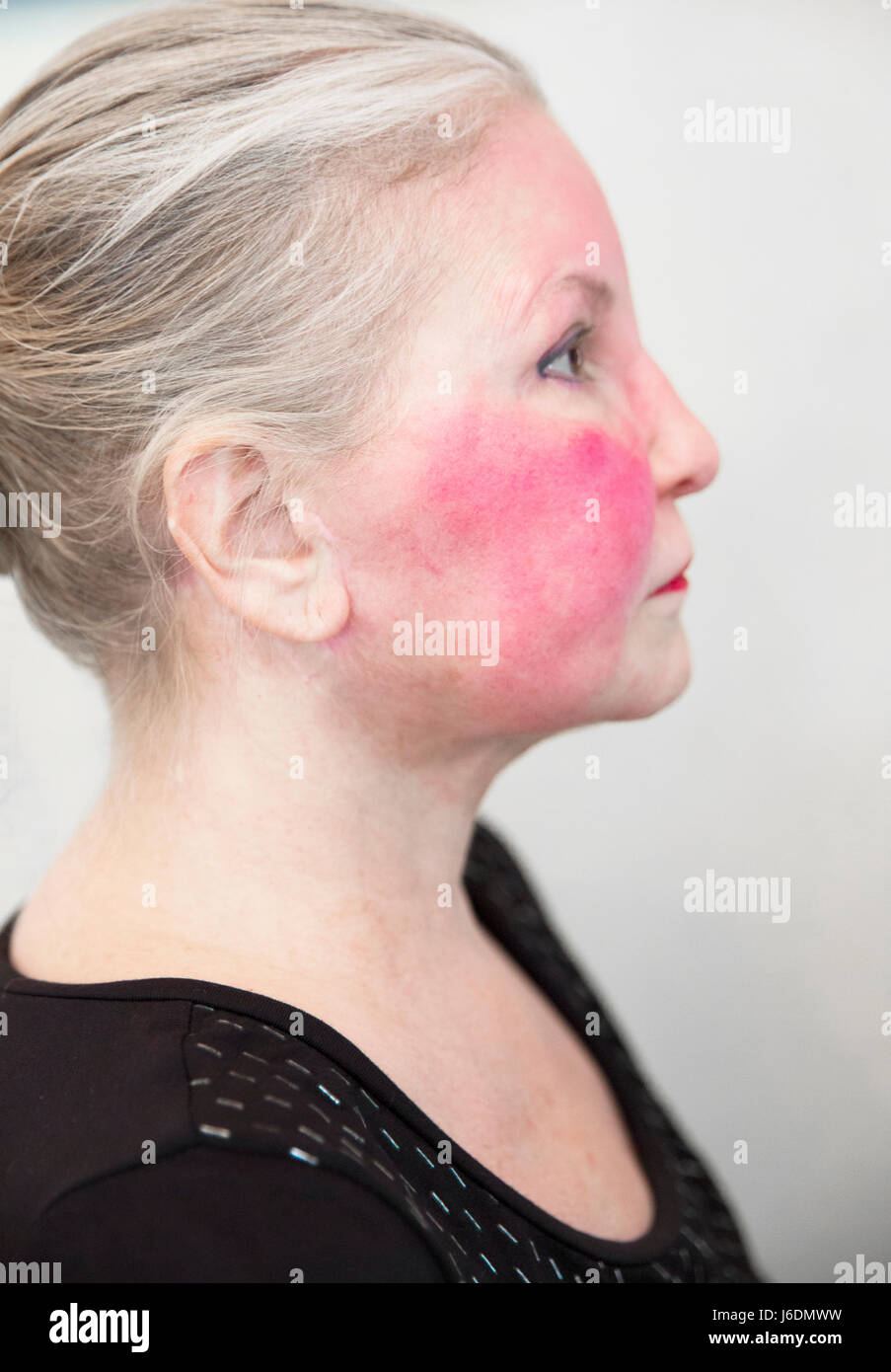 Side view of a Caucasian woman in her late fifties has an autoimmune disease or Rosacea that has caused a severe red flush on her face.  5D3 Stock Photo