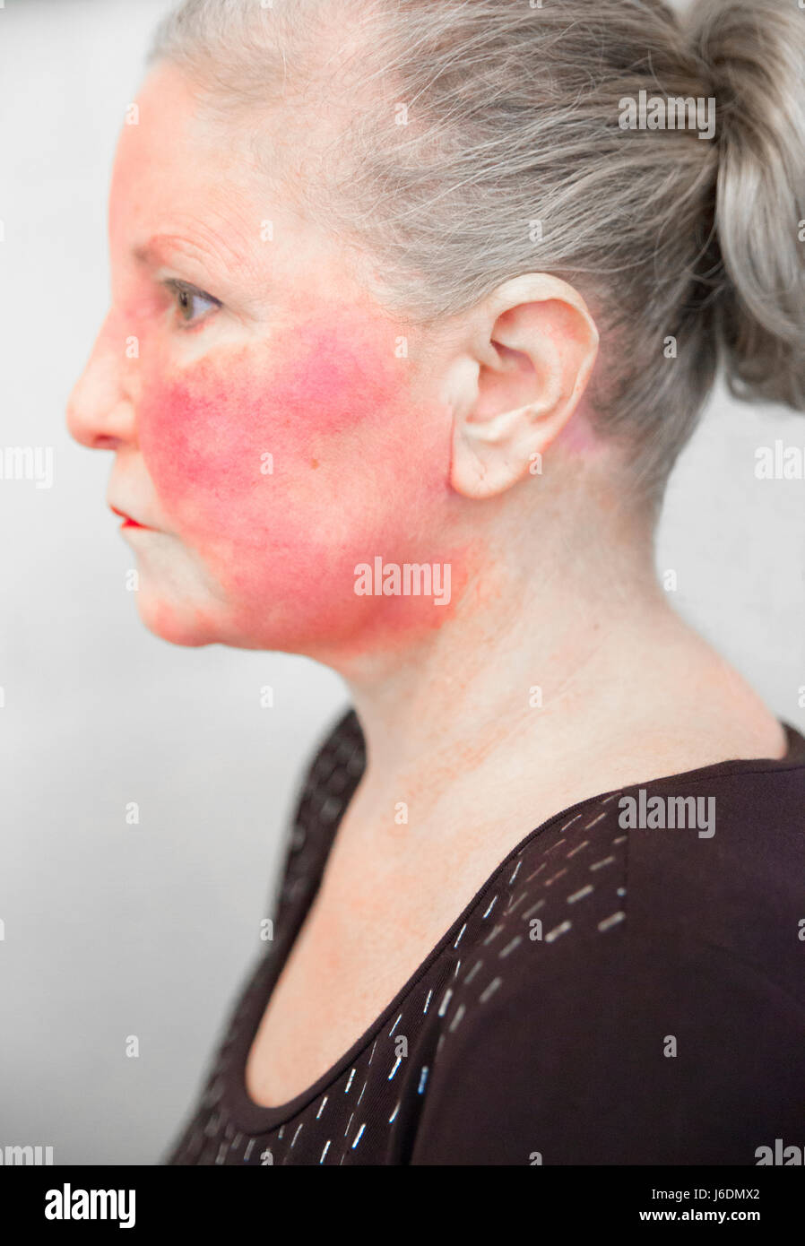 Side view of a Caucasian women in her late fifties has an autoimmune disease that has caused a severe red flush on her face. Shot with Canon 5D Mark 3 Stock Photo