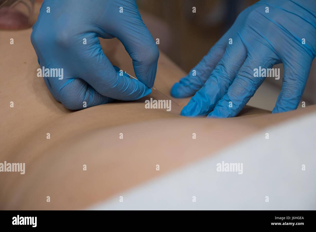 Dry needling technique by a physical therapist Stock Photo