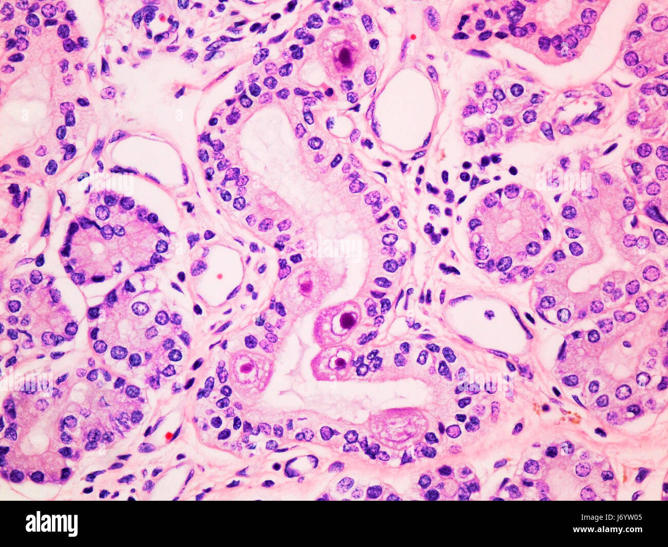 Cytomegalovirus CMV Infection in the Salivary Gland Viewed at 400x Magnification with Haemotoxylin and Eosin Staining. Stock Photo