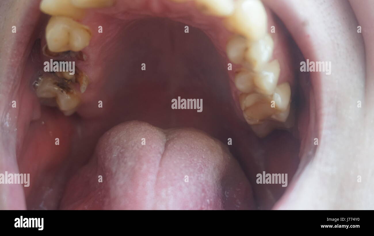 Yellow Tooth Human Rotten Bad teeth of a guy. Rotten and yellow teeth Stock Photo - Alamy