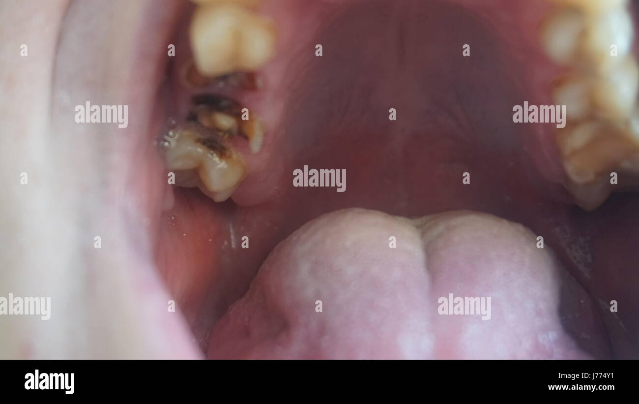 One Rotten Tooth Bad teeth of a guy. Rotten and yellow teeth Stock Photo - Alamy