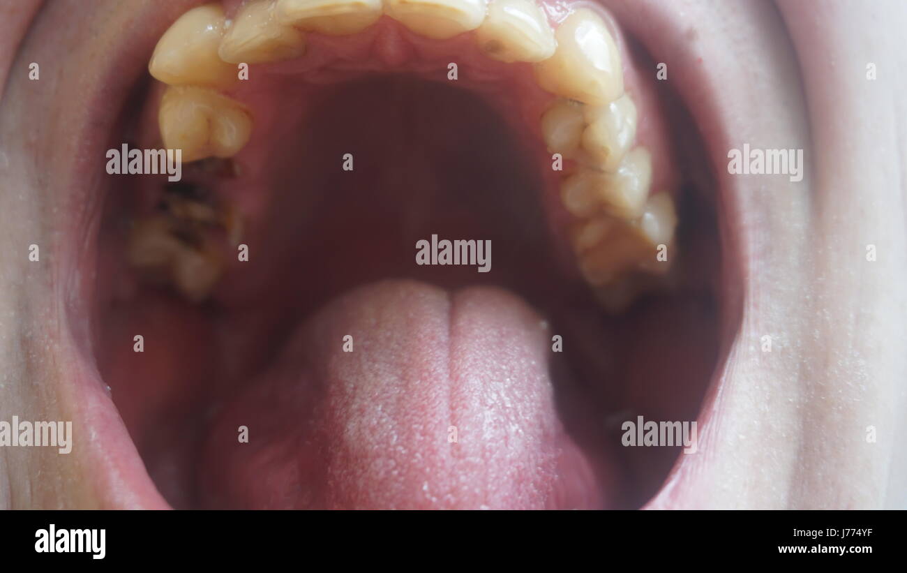 Bad teeth of a guy. Rotten and yellow teeth Stock Photo - Alamy
