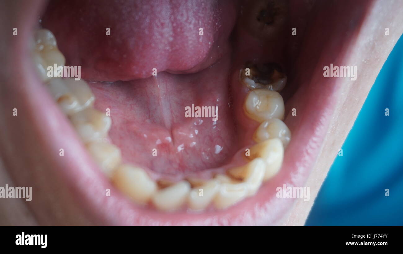 Bad teeth of a guy. Rotten and yellow teeth Stock Photo - Alamy
