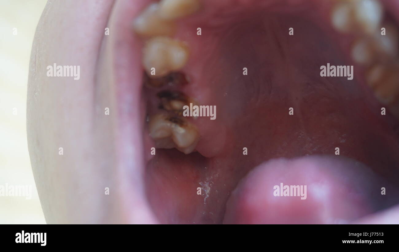 Bad teeth of a guy. Rotten and yellow teeth Stock Photo - Alamy