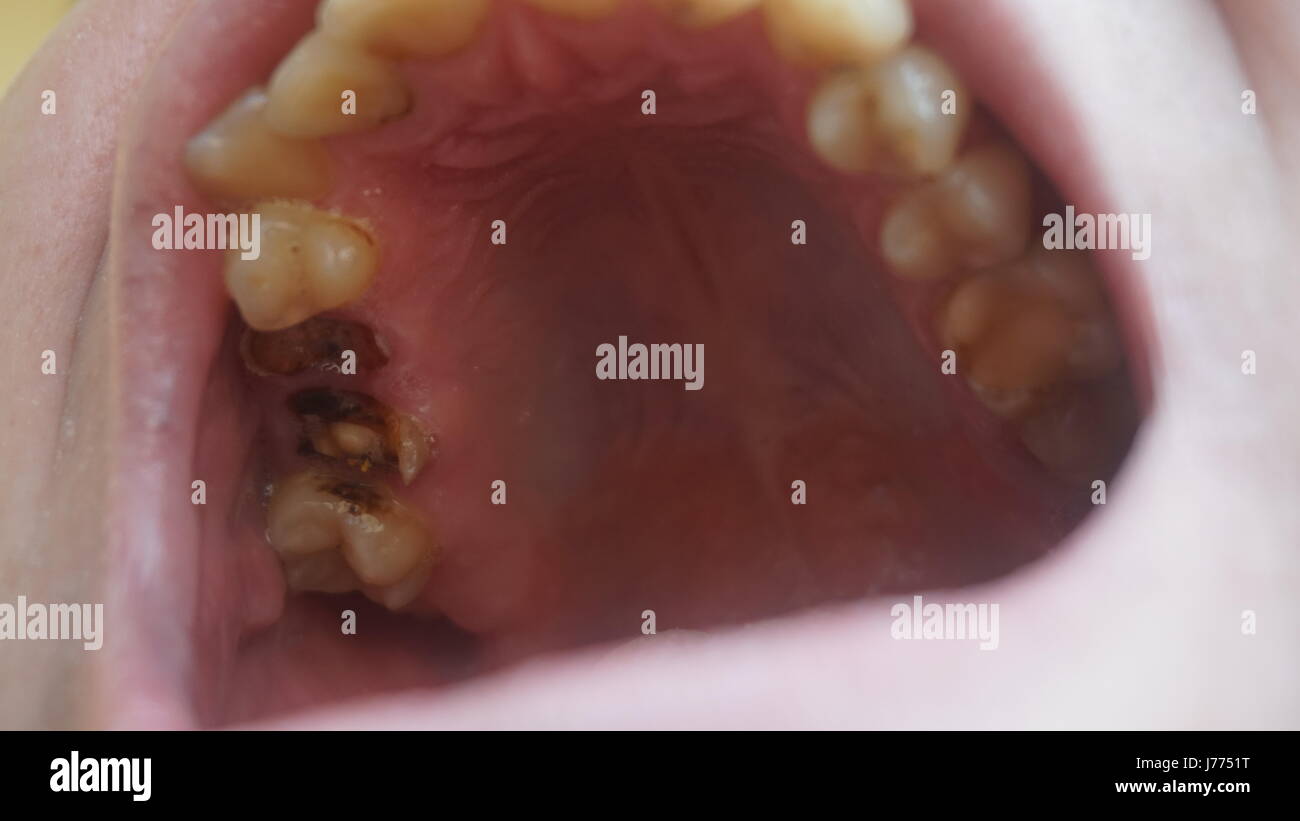 Bad teeth of a guy. Rotten and yellow teeth Stock Photo Alamy