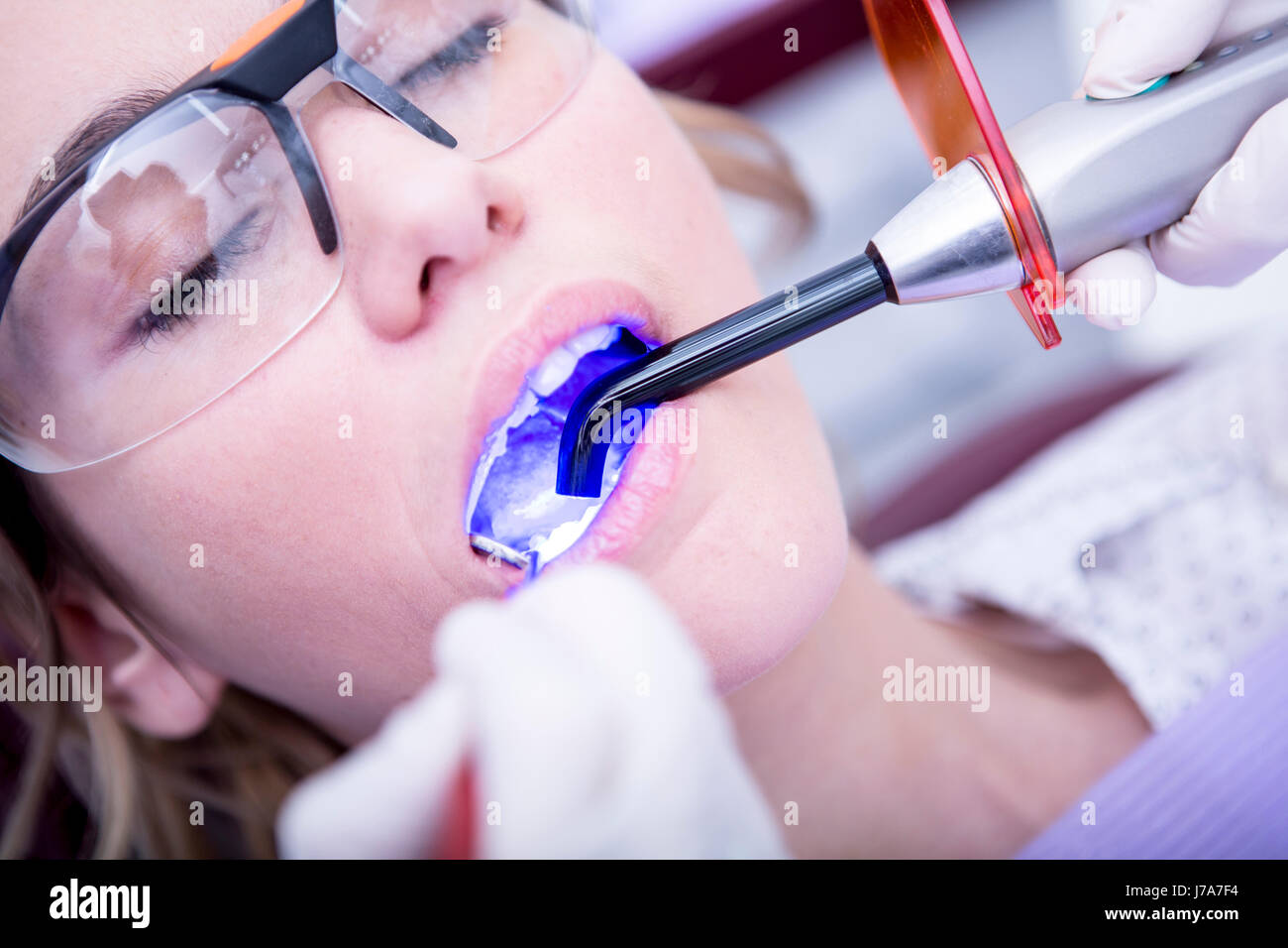 Hardening of dental filling at the dentist Stock Photo Alamy