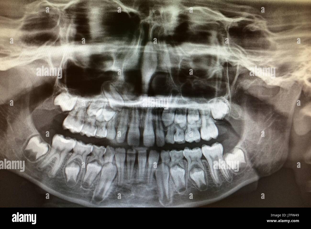 Panoramic Dental X-Ray of Childs Teeth Development Stock Photo