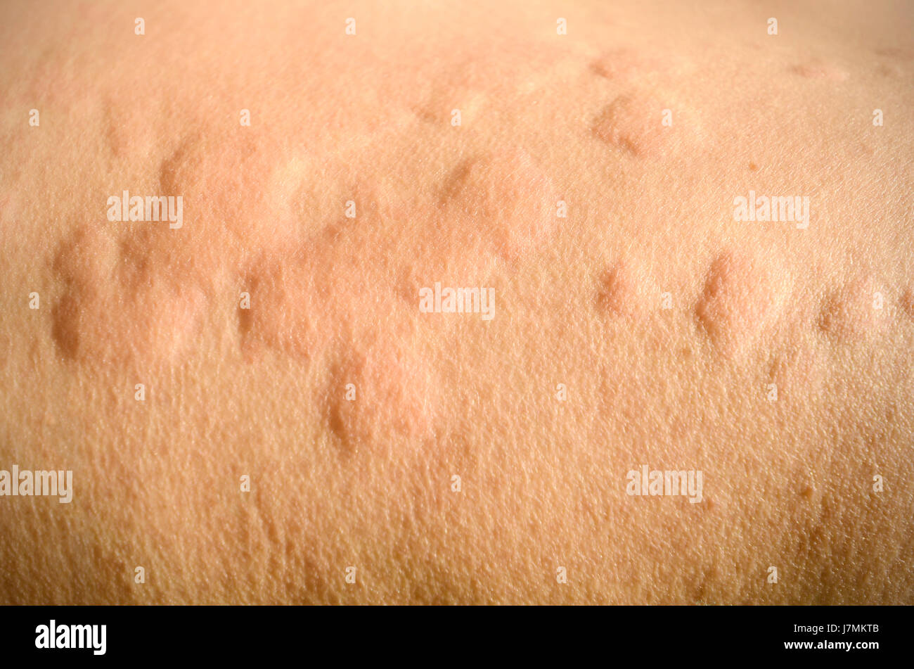Skin rash, Urticaria, Allergic skin reaction. Stock Photo