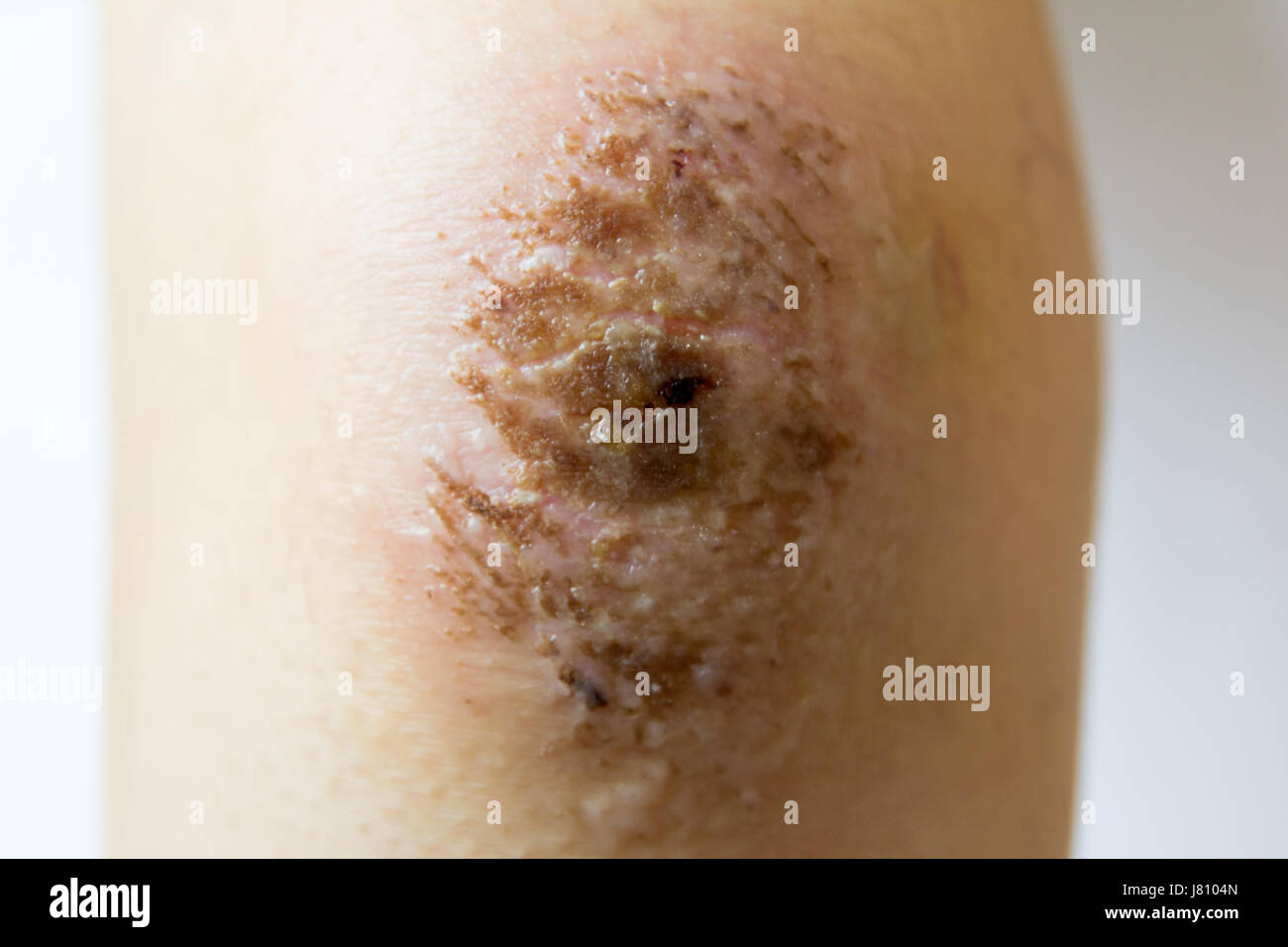 Closed up of red scab injury on woman knee background Stock Photo - Alamy