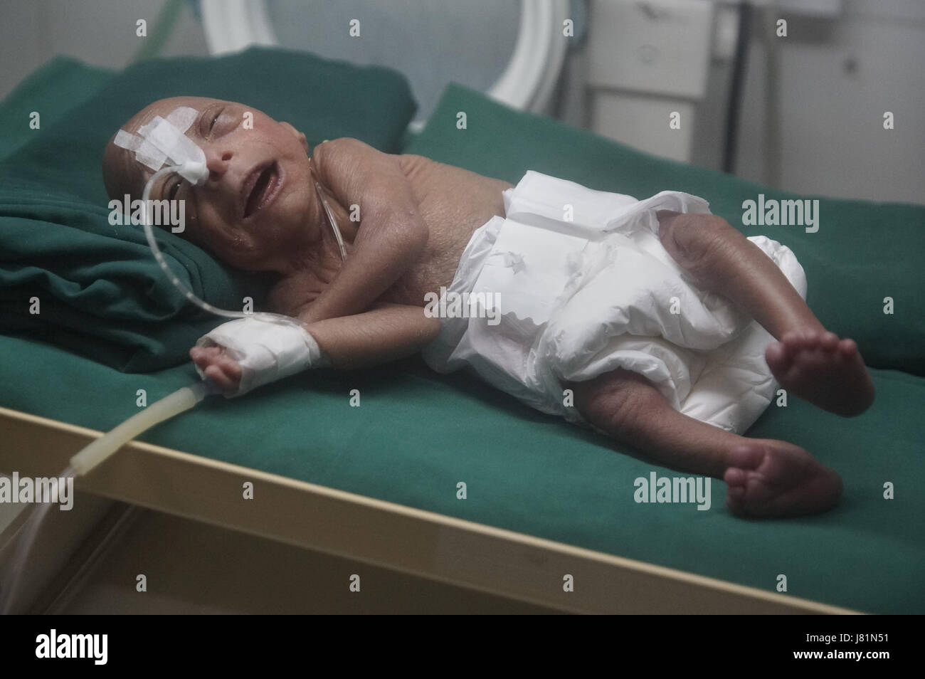 Hutchinson gilford progeria syndrome hires stock photography and