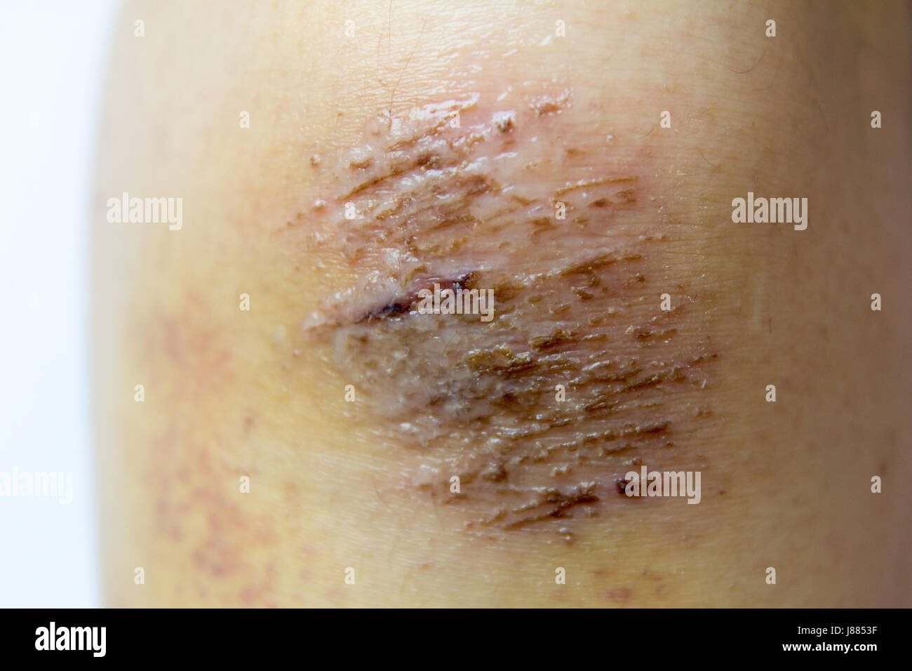 Closed up of red scab injury on woman knee background Stock Photo - Alamy