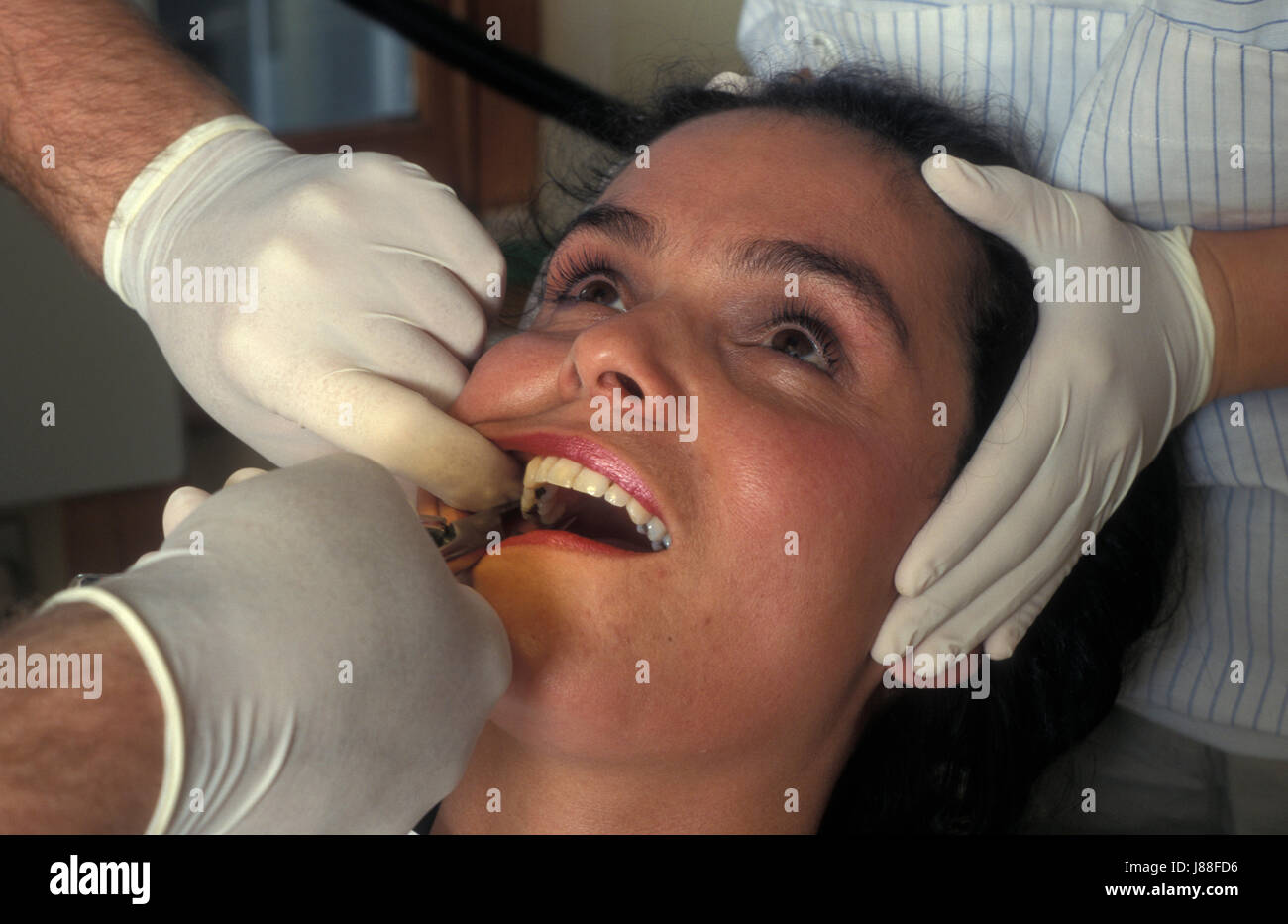 anglo-israeli woman at dentist having tooth extraction Stock Photo