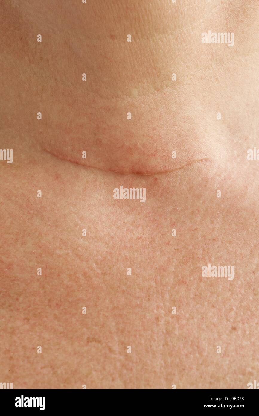 Thyroid Surgery High Resolution Stock Photography and Images Alamy