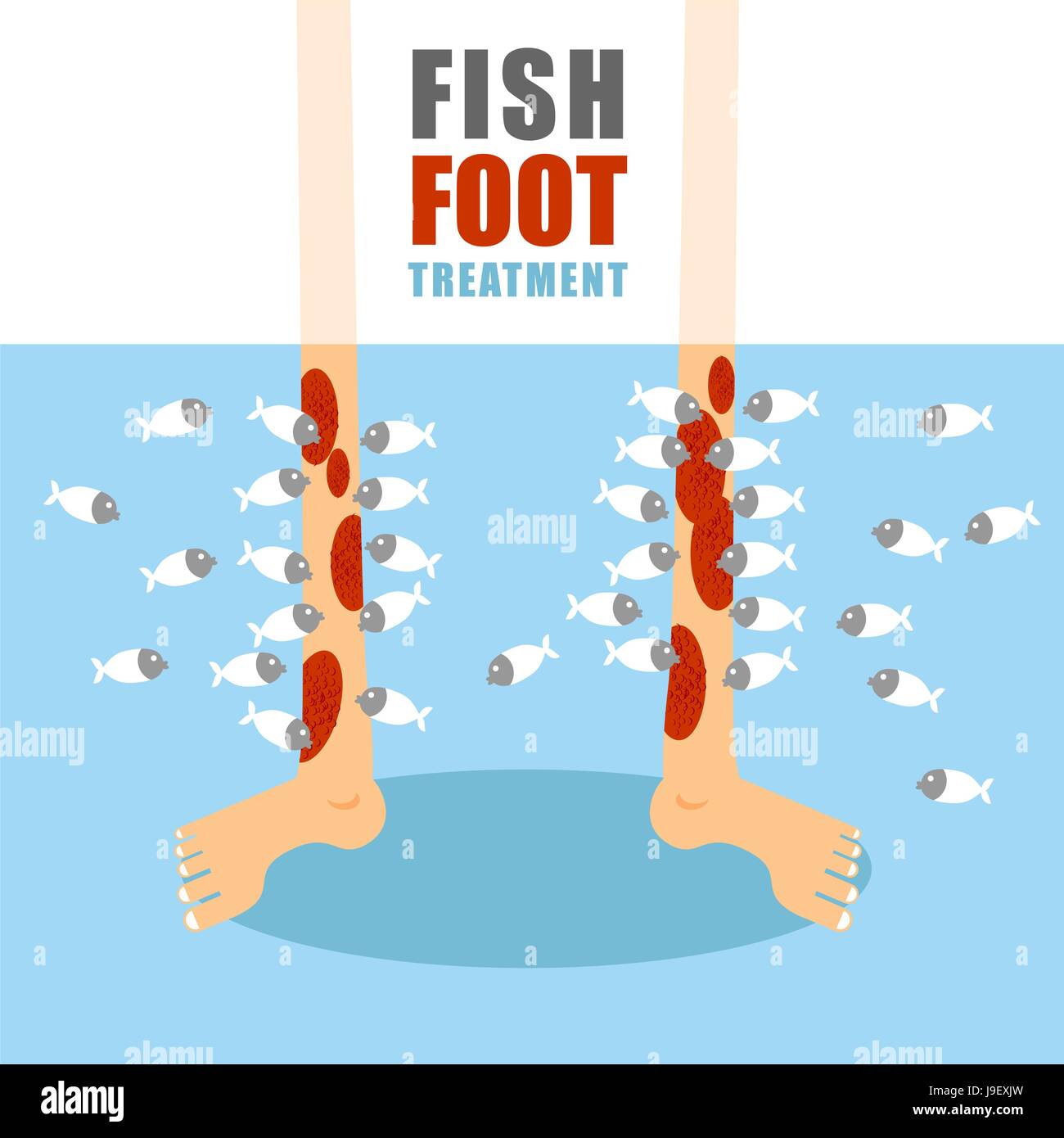 Treatment foot fish. Medical procedure for treatment of psoriasis and