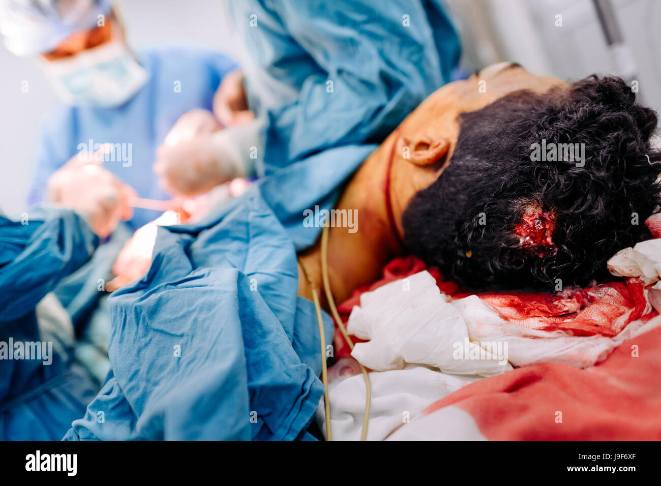 A young gang member, with a gunshot wound to the head, lies on the strecher during the life-saving surgery in the operating room of a public hospital in San Salvador, El Salvador, 16 December 2015. Stock Photo