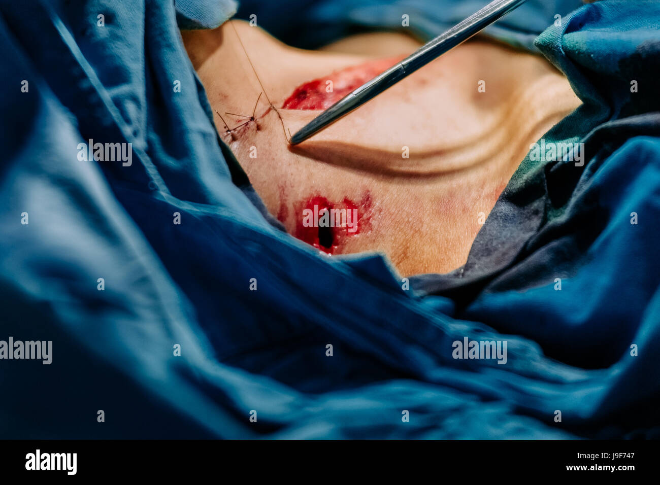 A surgeon stitches the skin of a a young gang member, after removing the bullet from an abdominal gunshot wound, during the life-saving surgery in the operating room of a public hospital in San Salvador, El Salvador, 14 February 2015. Stock Photo