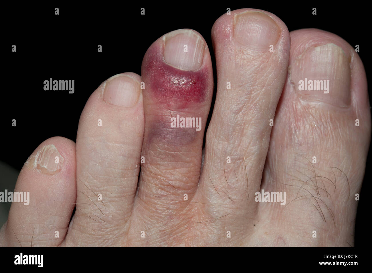 Broken toe: Treatments, symptoms, pictures, and healing time