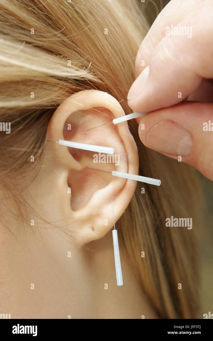 Ear electro-acupuncture - Stock Image - M745/0212 - Science Photo Library