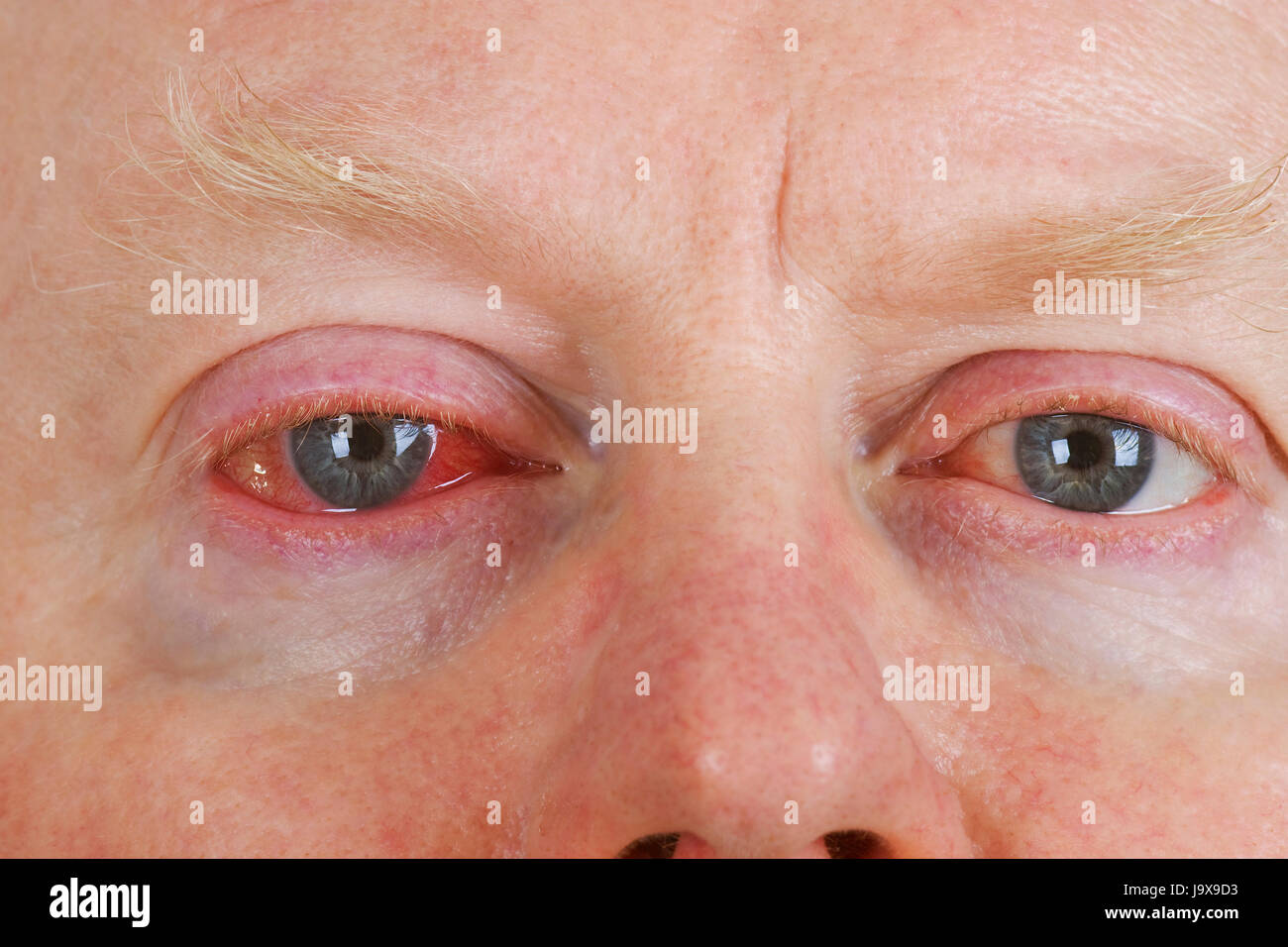Close up shot from man's wrinkled tired irritated bloodshot eye Stock