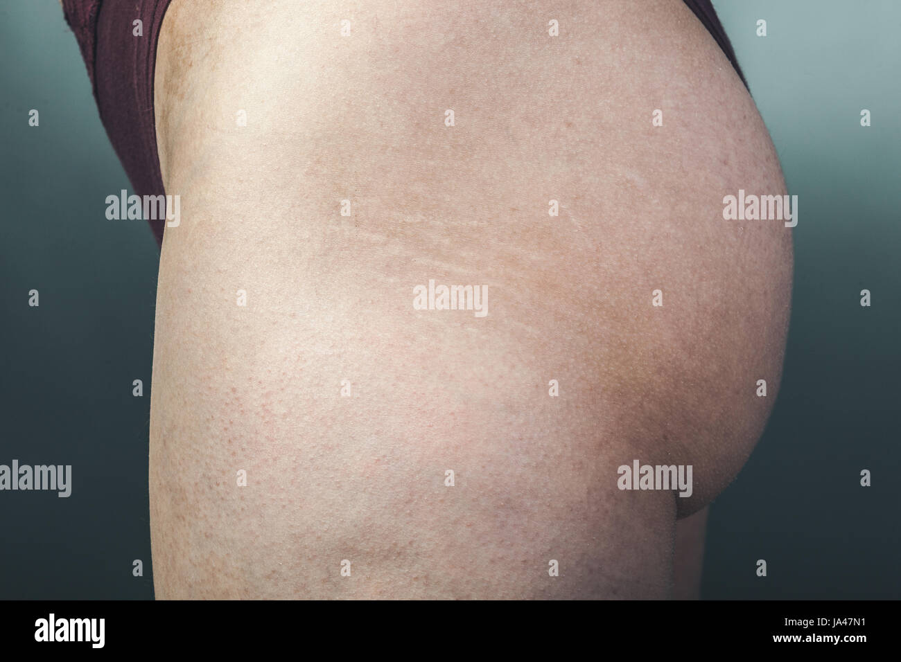 Stretch marks on the leg Stock Photo