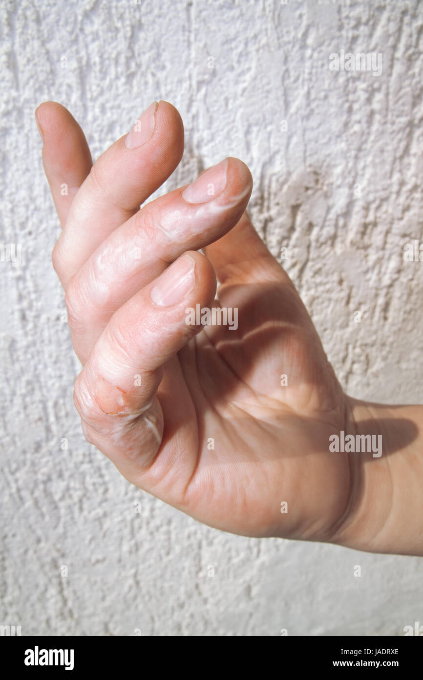 Scorched Flabby Skin on Fingers Stock Photo