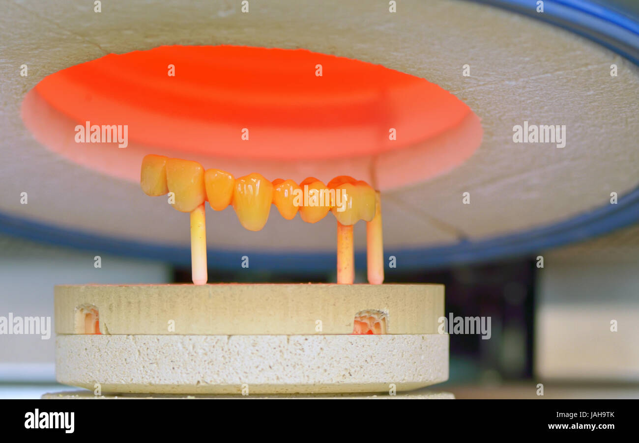 ceramic-metal compound crowns in furnace, dental technology Stock Photo ...