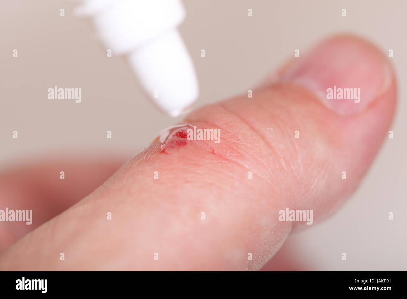 disinfect the scratch by rubbing in alcohol cuts on the hand Stock