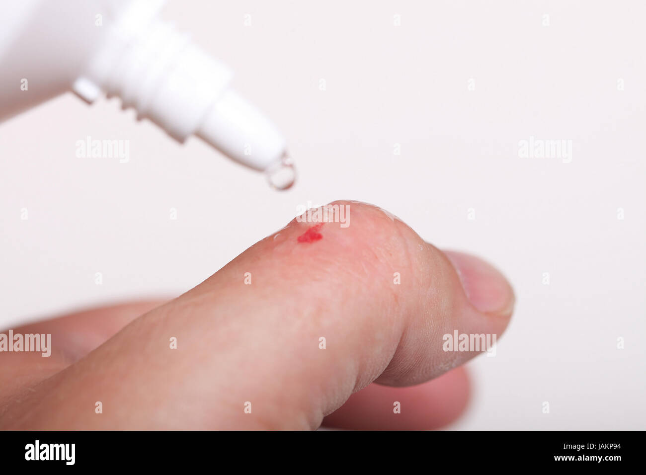 disinfect the scratch by rubbing in alcohol cuts on the hand Stock