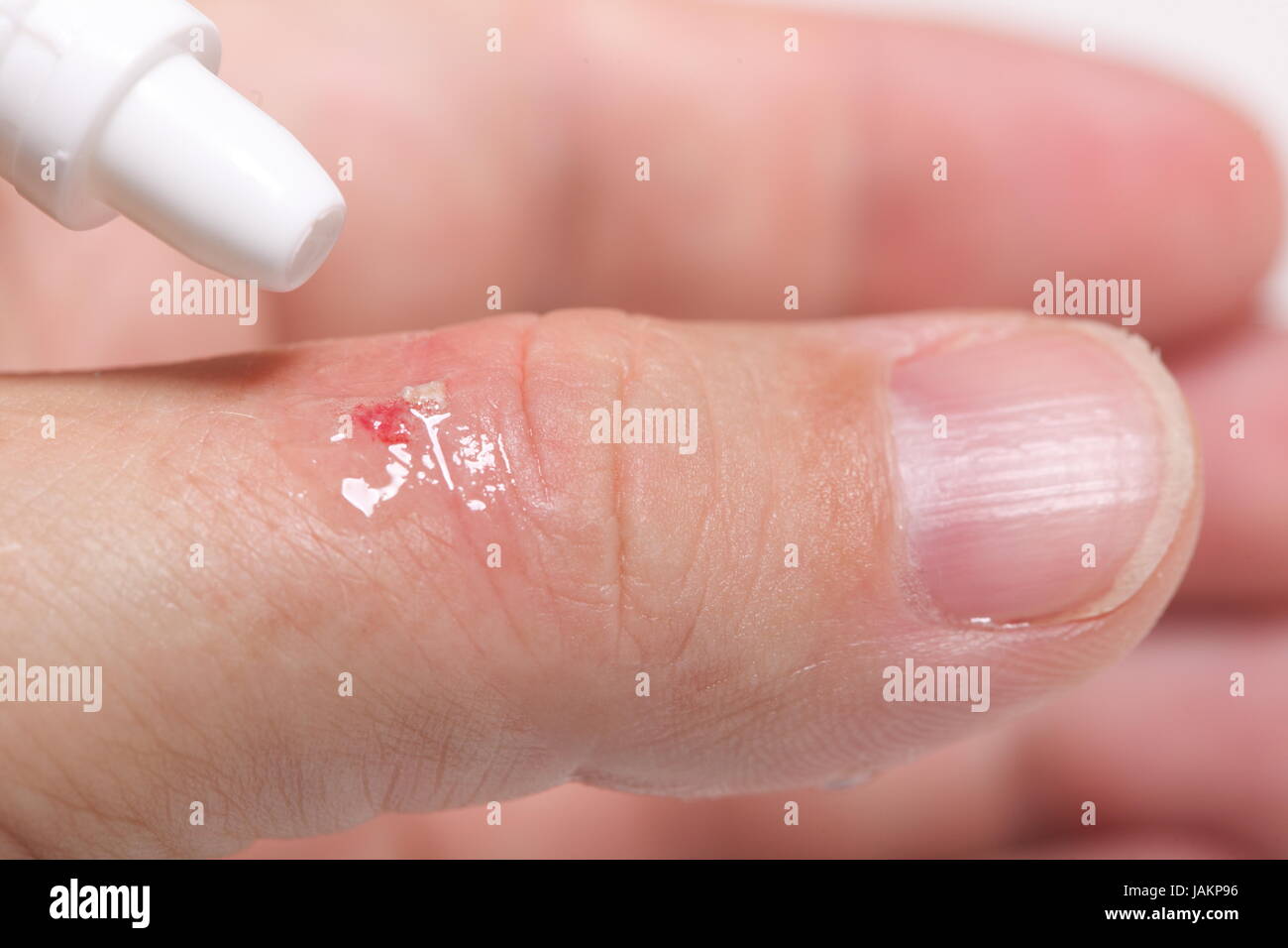 disinfect the scratch by rubbing in alcohol cuts on the hand Stock