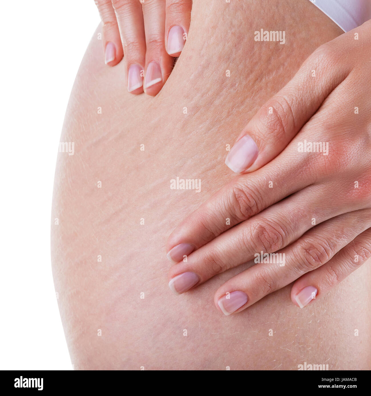 A woman is testing the skin on the thigh for the presence of stretch marks and cellulite Stock Photo