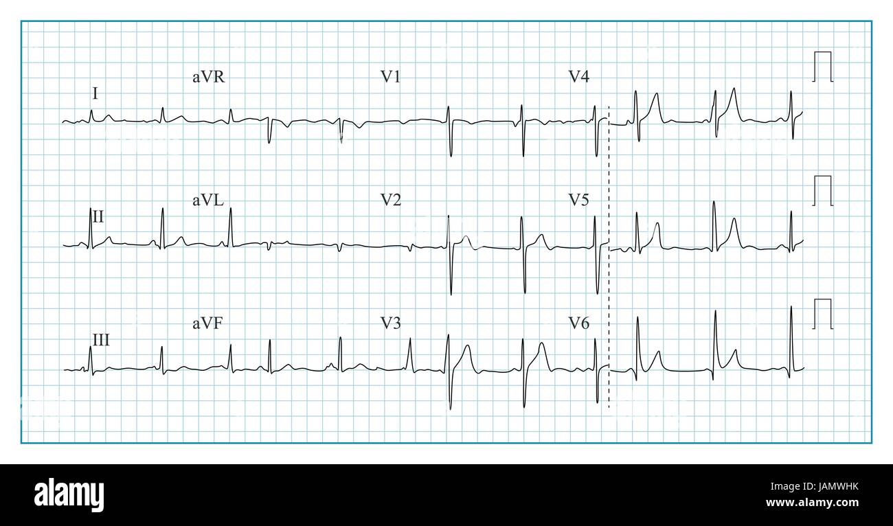 Heart Rhythm Chart