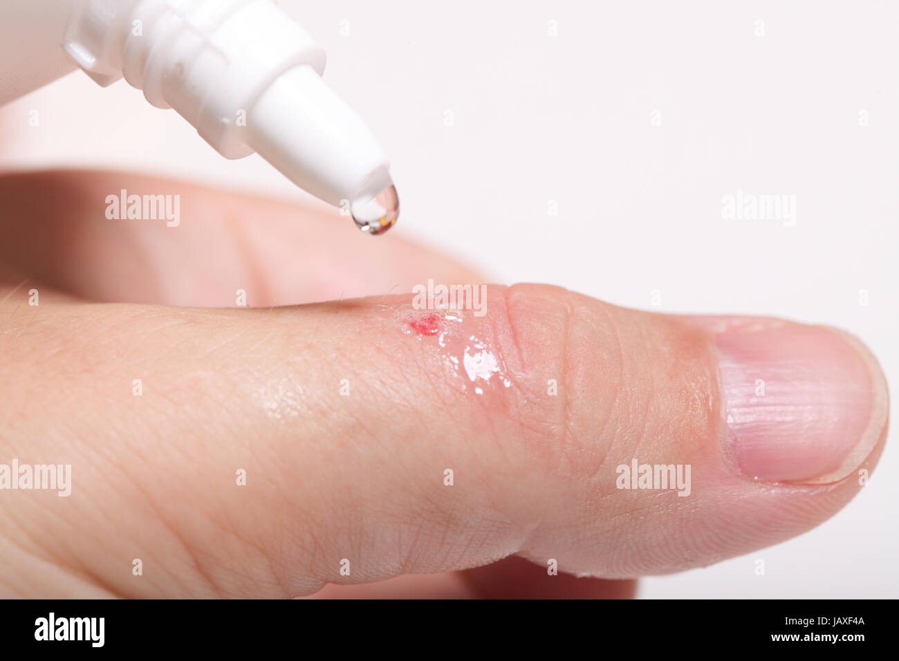disinfect the scratch by rubbing in alcohol cuts on the hand Stock