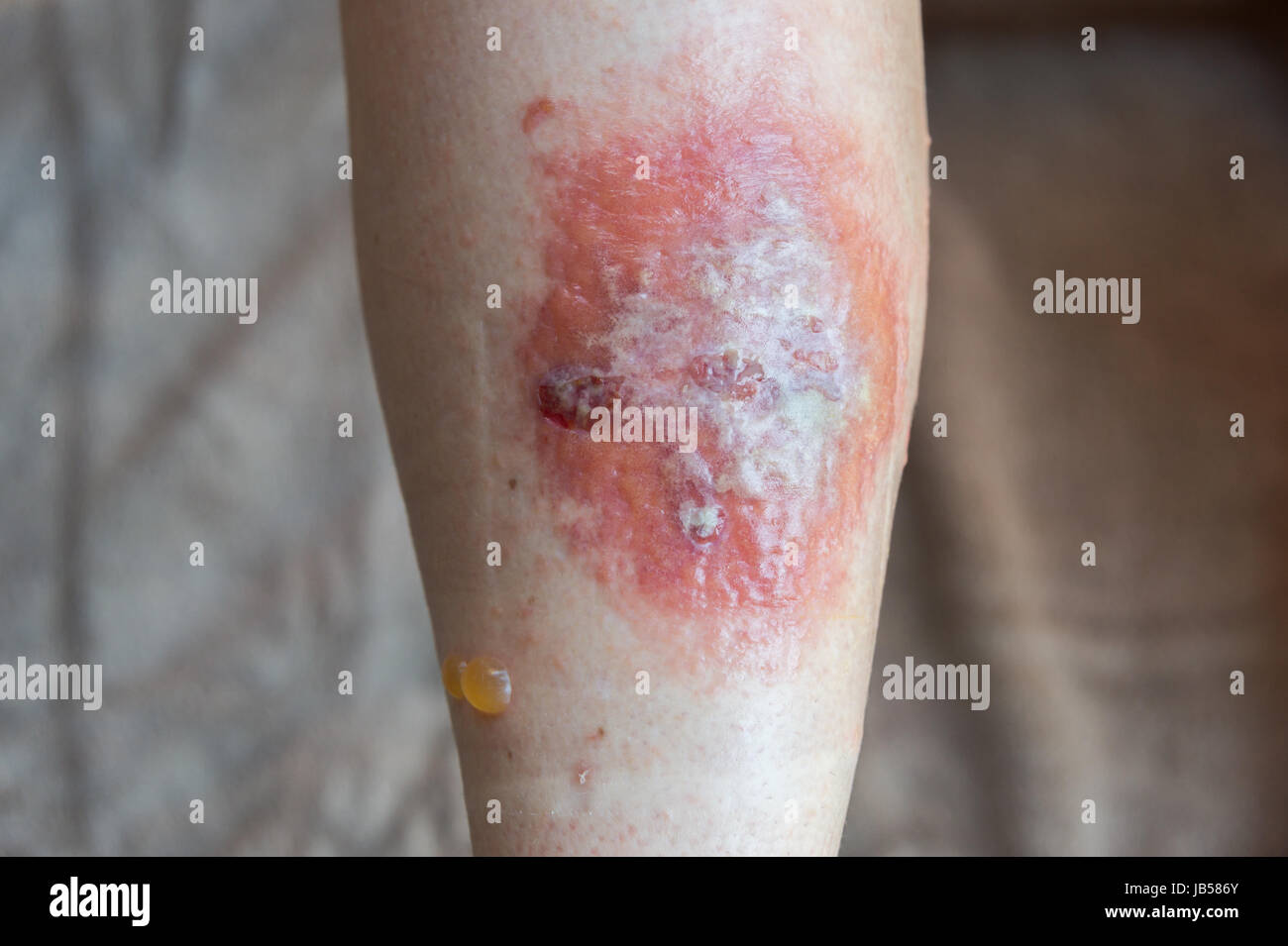 Poison Ivy rash and blisters on a leg Stock Photo