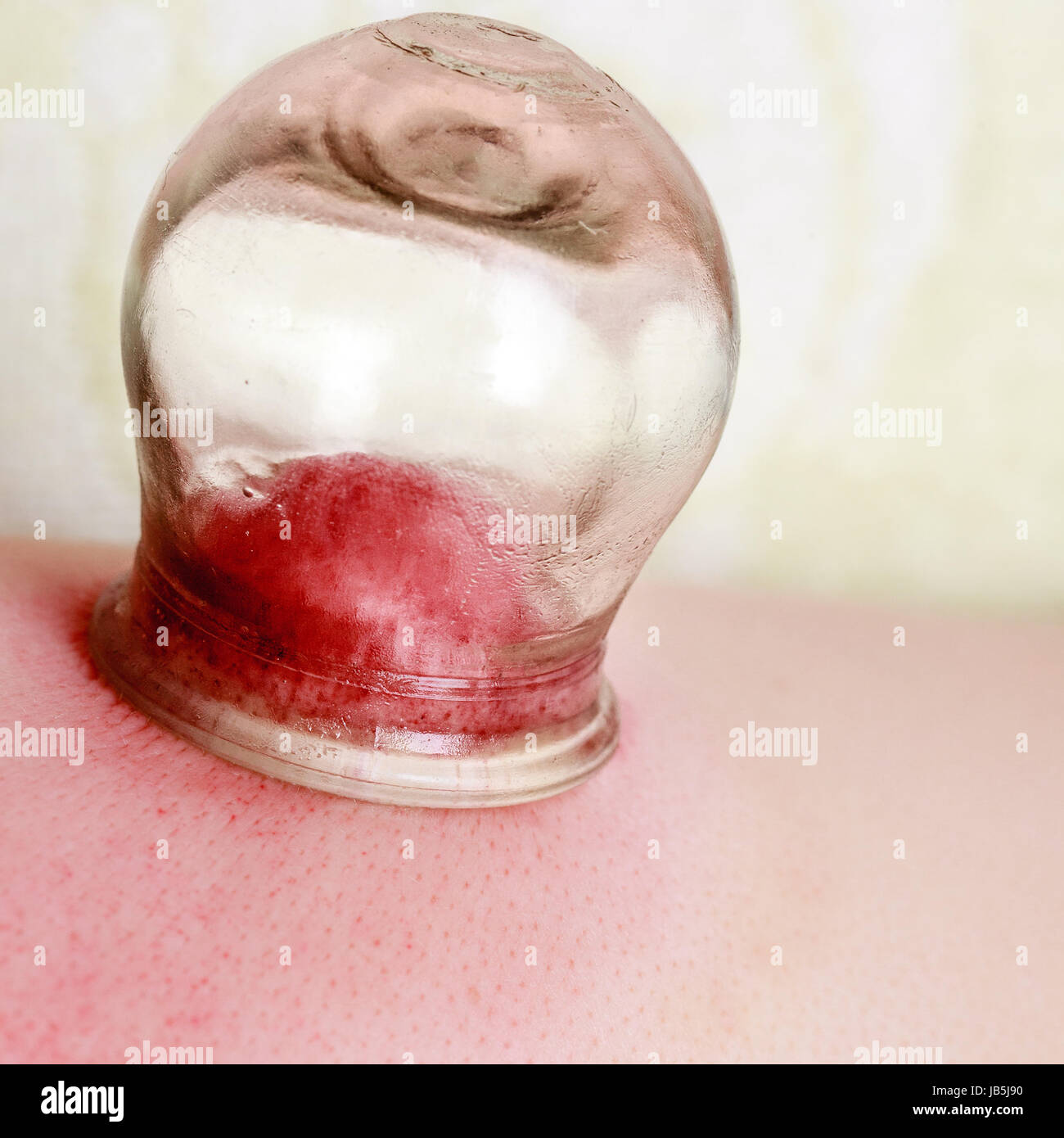 Alternative medicine health care. Fire cupping procedure, woman