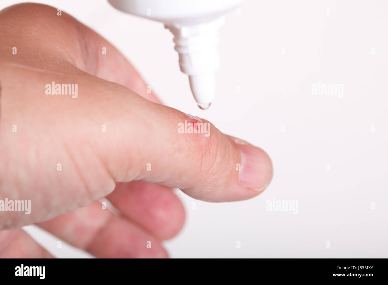 disinfect the scratch by rubbing in alcohol cuts on the hand Stock