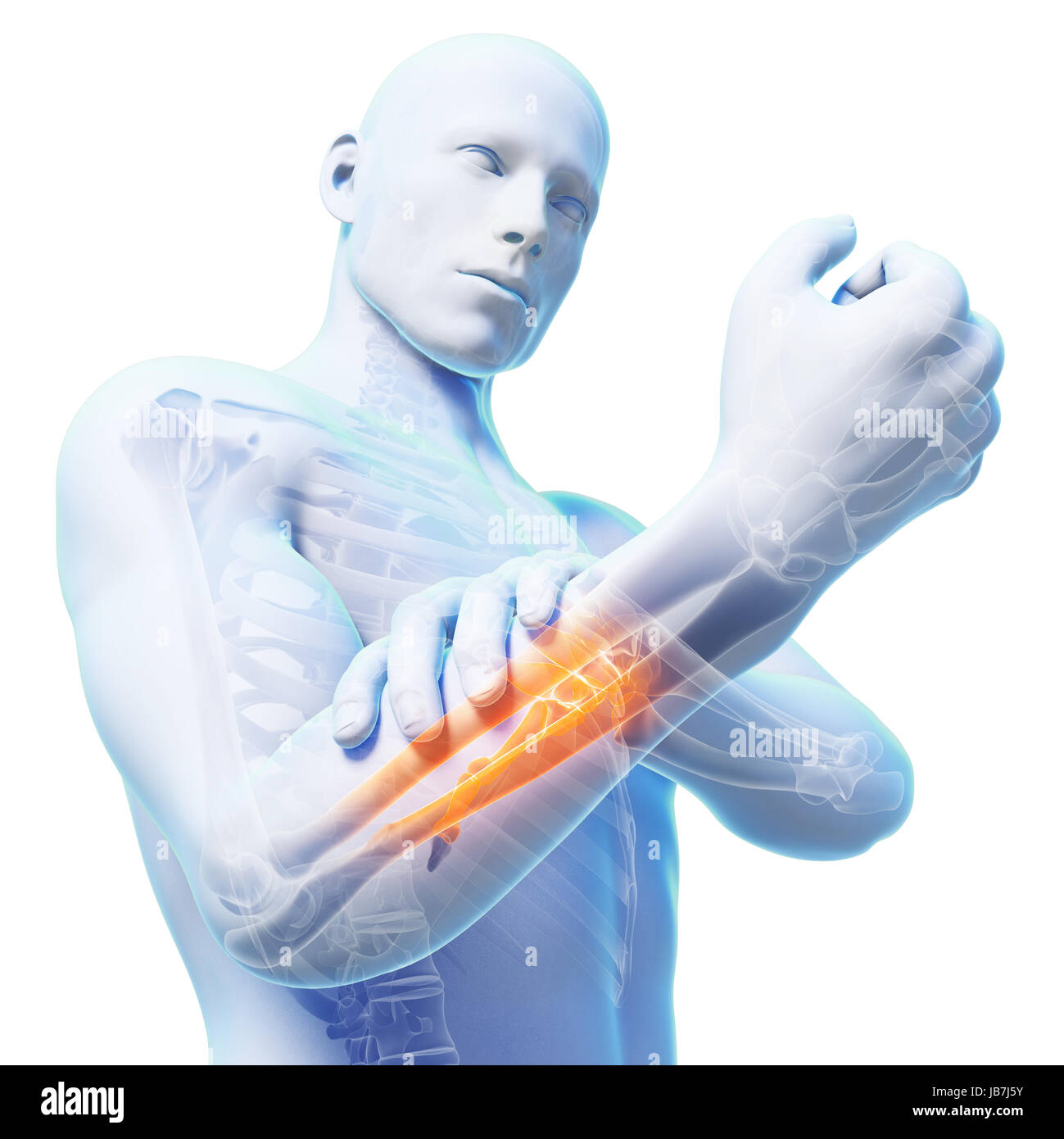 3d rendering illustration cartilage wear injury rheumatism 3d hi-res ...