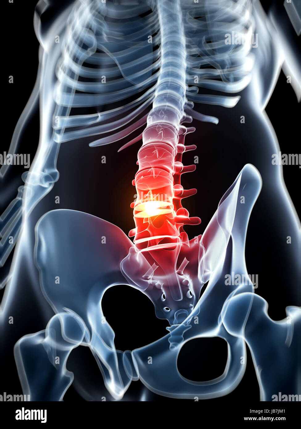 3d rendered illustration - herniated disk Stock Photo