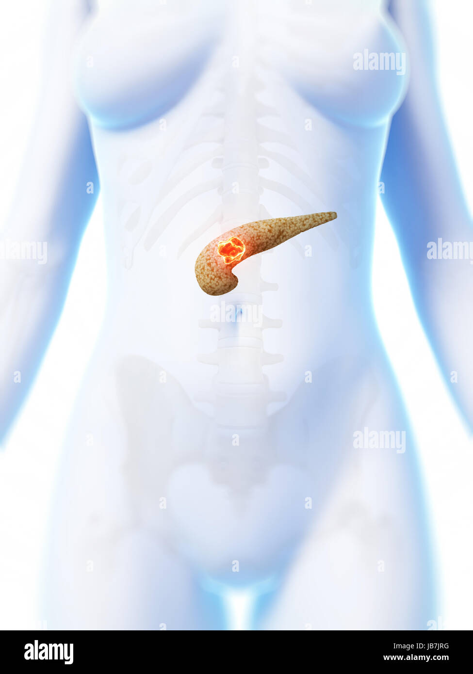 Inflamed inflammation cancerous abscess carcinoma metastasis ulcer ...