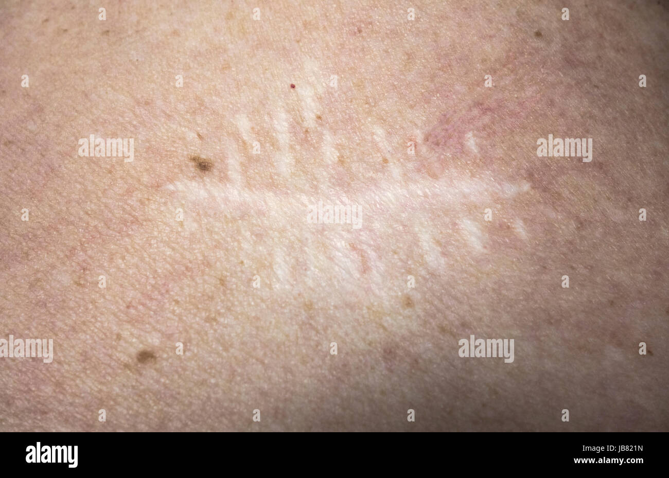 Ugly scar hi-res stock photography and images - Alamy