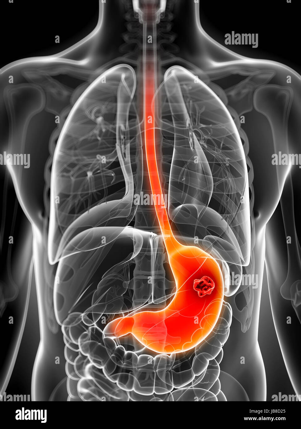 3d rendered illustration of the male stomach - cancer Stock Photo