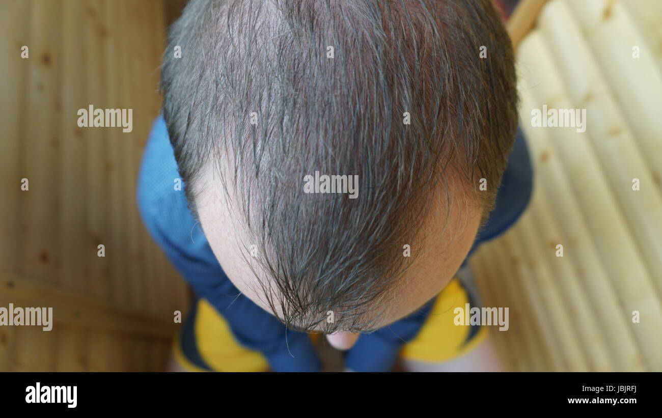 Male Head With Thinning Hair Or Alopecia Stock Photo 144857766